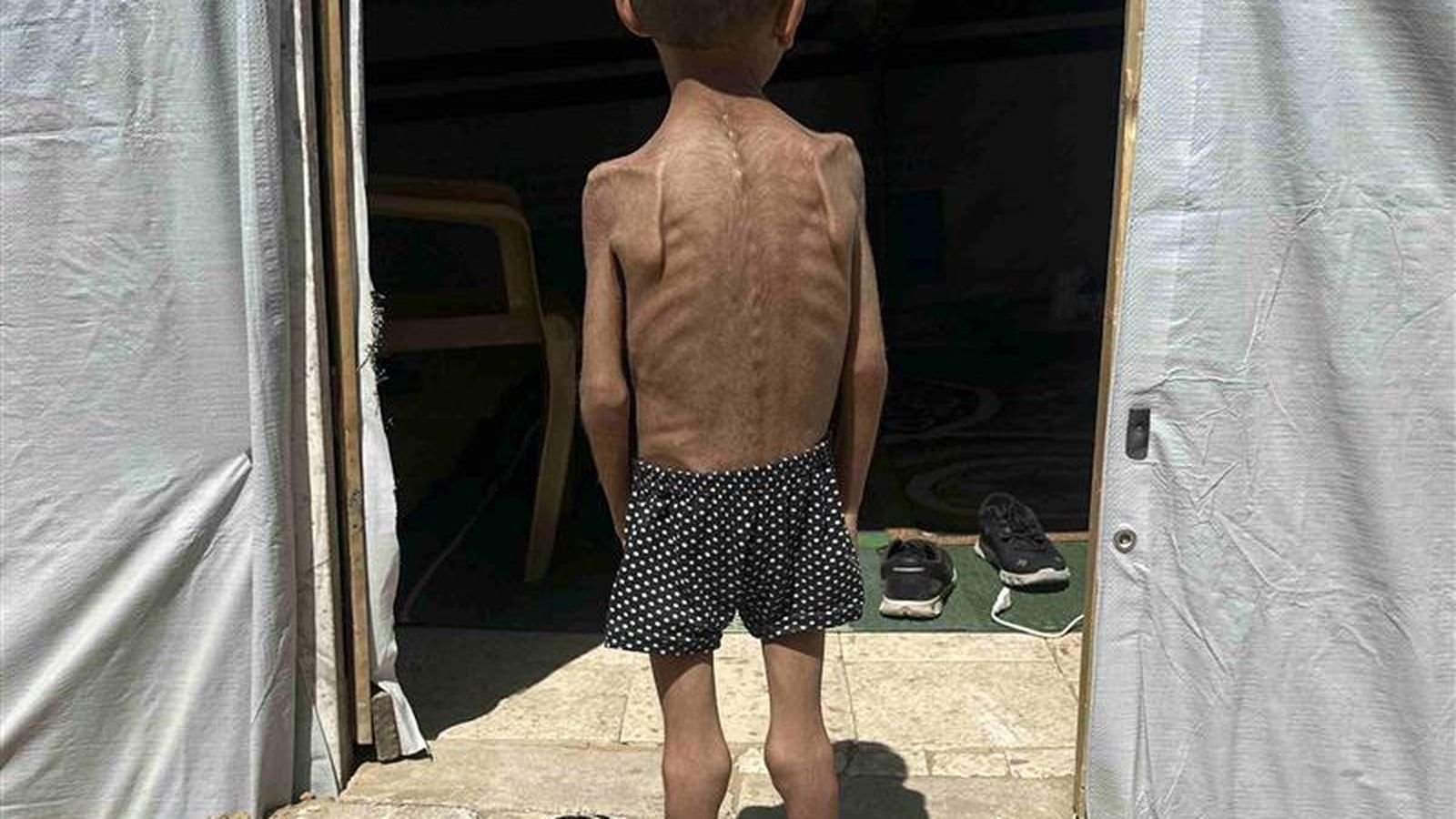 Niño desnutrido en Gaza