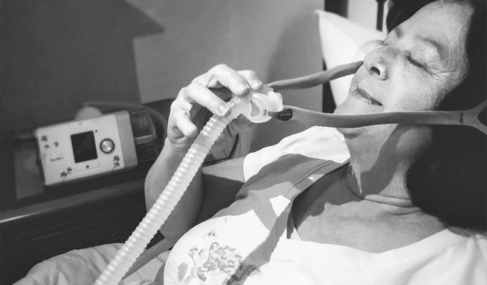 Apnea obstructiva del sueño