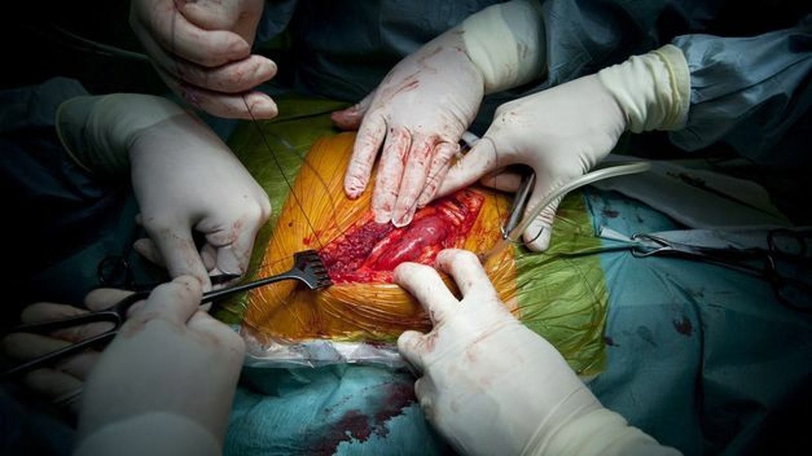 El "turismo de trasplantes", a debate en el Vaticano