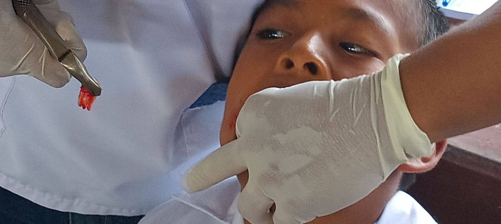 Extracción en campaña médica en Porvenir