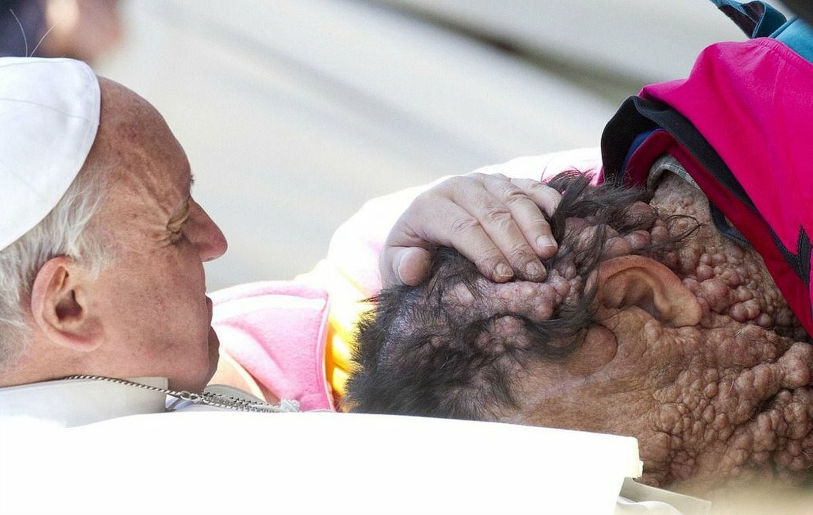 El Papa abraza a un hombre con el síndrome de Von Recklinhausen