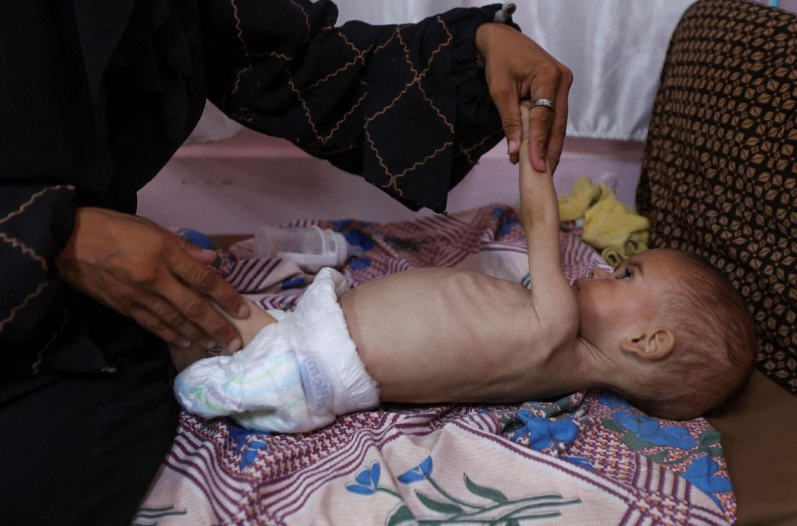 Niña palestina desnutrida recibe tratamiento en el Hospital Nasser de Khan Younis, en el sur de la Franja de Gaza