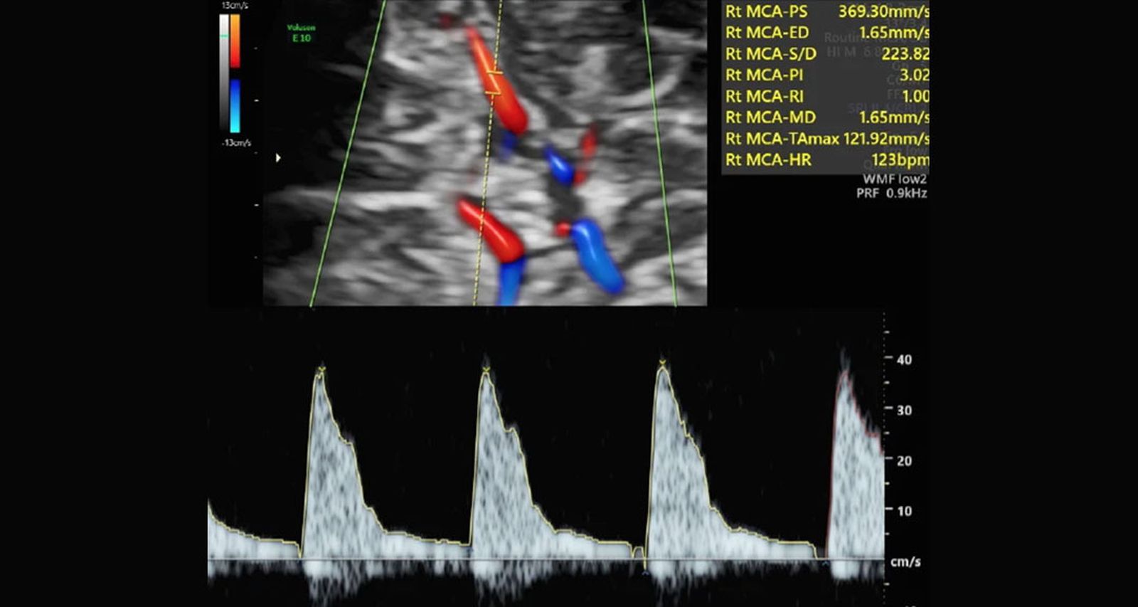Ensayo clínico RATIO37